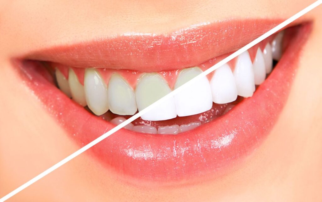 5 Alasan Mengapa Anda Harus Mempertimbangkan Bleaching Gigi