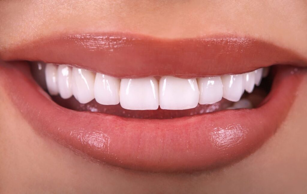 6 Tanda Anda Mungkin Membutuhkan Veneer Gigi