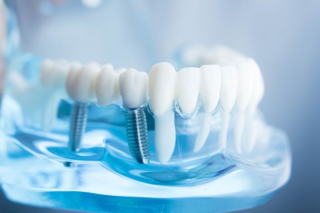4 Alasan Untuk Menemui Klinik Dental Implant Jakarta yang Profesional