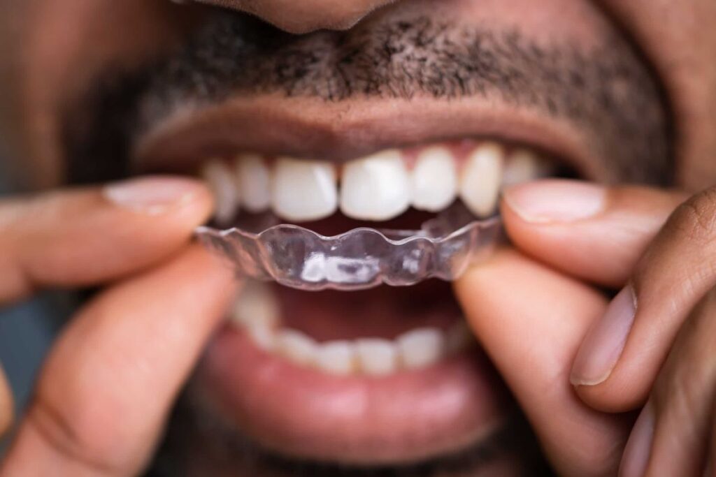 Apa itu Invisalign dan Bagaimana Cara Kerjanya?