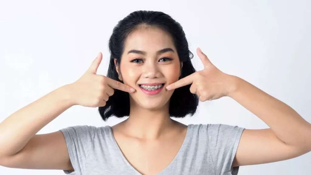 Panduan Singkat untuk Pasang Behel Kawat Gigi